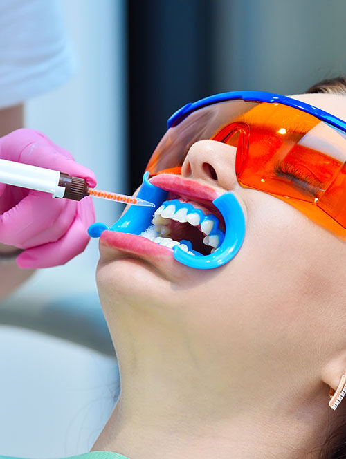 In-office Teeth Whitening
