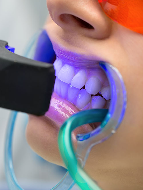 In-office Teeth Whitening